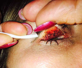 Illustration for article titled Este es el espantoso resultado de una mujer que durmió más de 25 años con maquillaje en los ojos